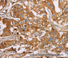 Immunohistochemistry of paraffin-embedded Human breast cancer using LTF Polyclonal Antibody at dilution of 1:40