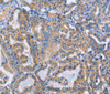 Immunohistochemistry of paraffin-embedded Human thyroid cancer tissue using DOK4 Polyclonal Antibody at dilution 1:50