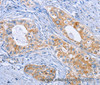 Immunohistochemistry of paraffin-embedded Human cervical cancer tissue using DOK4 Polyclonal Antibody at dilution 1:50