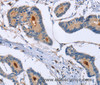 Immunohistochemistry of paraffin-embedded Human colon cancer using GMFG Polyclonal Antibody at dilution of 1:50