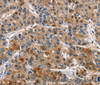 Immunohistochemistry of paraffin-embedded Human liver cancer tissue using PIM1 Polyclonal Antibody at dilution 1:40