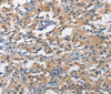 Immunohistochemistry of paraffin-embedded Human thyroid cancer tissue using PIM1 Polyclonal Antibody at dilution 1:40