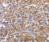 Immunohistochemistry of paraffin-embedded Human thyroid cancer tissue using PIM2 Polyclonal Antibody at dilution 1:40