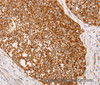 Immunohistochemistry of paraffin-embedded Human cervical cancer using AK2 Polyclonal Antibody at dilution of 1:40