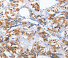 Immunohistochemistry of paraffin-embedded Human thyroid cancer tissue using HK2 Polyclonal Antibody at dilution 1:40