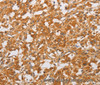 Immunohistochemistry of paraffin-embedded Human thyroid cancer tissue using OLR1 Polyclonal Antibody at dilution 1:50