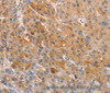 Immunohistochemistry of paraffin-embedded Human liver cancer tissue using OLR1 Polyclonal Antibody at dilution 1:50