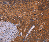 Immunohistochemistry of paraffin-embedded Human cervical cancer tissue using CDC5L Polyclonal Antibody at dilution 1:40