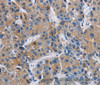 Immunohistochemistry of paraffin-embedded Human liver cancer using GPM6A Polyclonal Antibody at dilution of 1:40