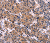 Immunohistochemistry of paraffin-embedded Human liver cancer tissue using EIF2AK4 Polyclonal Antibody at dilution 1:50