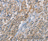 Immunohistochemistry of paraffin-embedded Human esophagus cancer using CBR1 Polyclonal Antibody at dilution of 1:40