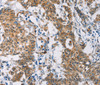 Immunohistochemistry of paraffin-embedded Human gastric cancer tissue using CERK Polyclonal Antibody at dilution 1:30