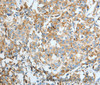 Immunohistochemistry of paraffin-embedded Human breast cancer using ASAH1 Polyclonal Antibody at dilution of 1:50