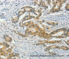 Immunohistochemistry of paraffin-embedded Human colon cancer tissue using ASB8 Polyclonal Antibody at dilution 1:50