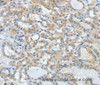 Immunohistochemistry of paraffin-embedded Human thyroid cancer tissue using ASH2L Polyclonal Antibody at dilution 1:60