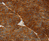 Immunohistochemistry of paraffin-embedded Human liver cancer using ASGR1 Polyclonal Antibody at dilution of 1:50