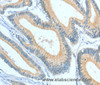 Immunohistochemistry of paraffin-embedded Human colon cancer using ASGR1 Polyclonal Antibody at dilution of 1:50