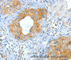Immunohistochemistry of paraffin-embedded Human cervical cancer using ASNS Polyclonal Antibody at dilution of 1:60