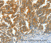 Immunohistochemistry of paraffin-embedded Human gastric cancer using ASNS Polyclonal Antibody at dilution of 1:60