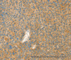 Immunohistochemistry of paraffin-embedded Human liver cancer tissue using AANAT Polyclonal Antibody at dilution 1:40