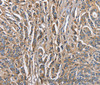 Immunohistochemistry of paraffin-embedded Human prostate cancer tissue using ABI3BP Polyclonal Antibody at dilution 1:60