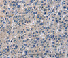 Immunohistochemistry of paraffin-embedded Human liver cancer tissue using ABI3BP Polyclonal Antibody at dilution 1:60