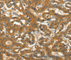 Immunohistochemistry of paraffin-embedded Human thyroid cancer using ADCY3 Polyclonal Antibody at dilution of 1:50