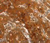 Immunohistochemistry of paraffin-embedded Human lung cancer using ORM2 Polyclonal Antibody at dilution of 1:40