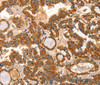 Immunohistochemistry of paraffin-embedded Human thyroid cancer tissue using IKZF3 Polyclonal Antibody at dilution 1:60