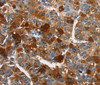 Immunohistochemistry of paraffin-embedded Human liver cancer using ARMCX2 Polyclonal Antibody at dilution of 1:40