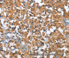 Immunohistochemistry of paraffin-embedded Human thyroid cancer using ARMCX2 Polyclonal Antibody at dilution of 1:40