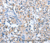 Immunohistochemistry of paraffin-embedded Human thyroid cancer tissue using ASB2 Polyclonal Antibody at dilution 1:50