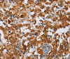 Immunohistochemistry of paraffin-embedded Human thyroid cancer tissue using ATXN1 Polyclonal Antibody at dilution 1:40
