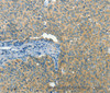 Immunohistochemistry of paraffin-embedded Human cervical cancer tissue using BCAT1 Polyclonal Antibody at dilution 1:50