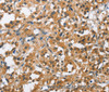 Immunohistochemistry of paraffin-embedded Human thyroid cancer using BCL10 Polyclonal Antibody at dilution of 1:40