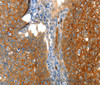 Immunohistochemistry of paraffin-embedded Human cervical cancer tissue using VWA5A Polyclonal Antibody at dilution 1:80