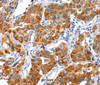Immunohistochemistry of paraffin-embedded Human lung cancer tissue using VWA5A Polyclonal Antibody at dilution 1:80