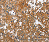 Immunohistochemistry of paraffin-embedded Human thyroid cancer tissue using BGN Polyclonal Antibody at dilution 1:50