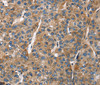 Immunohistochemistry of paraffin-embedded Human liver cancer tissue using BGN Polyclonal Antibody at dilution 1:50