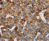 Immunohistochemistry of paraffin-embedded Human liver cancer tissue using SLAMF8 Polyclonal Antibody at dilution 1:40