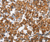 Immunohistochemistry of paraffin-embedded Human thyroid cancer tissue using SLAMF8 Polyclonal Antibody at dilution 1:40
