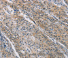 Immunohistochemistry of paraffin-embedded Human gastric cancer using BMP15 Polyclonal Antibody at dilution of 1:40