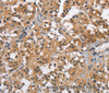 Immunohistochemistry of paraffin-embedded Human thyroid cancer using BABAM2 Polyclonal Antibody at dilution of 1:40