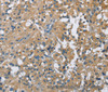Immunohistochemistry of paraffin-embedded Human thyroid cancer using CAB39L Polyclonal Antibody at dilution of 1:40
