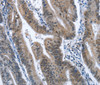 Immunohistochemistry of paraffin-embedded Human colon cancer tissue using CADM3 Polyclonal Antibody at dilution 1:40