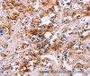 Immunohistochemistry of paraffin-embedded Human thyroid cancer using CALB1 Polyclonal Antibody at dilution of 1:60