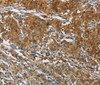 Immunohistochemistry of paraffin-embedded Human gastic cancer using CAST Polyclonal Antibody at dilution of 1:70