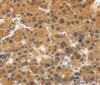 Immunohistochemistry of paraffin-embedded Human liver cancer tissue using CALU Polyclonal Antibody at dilution 1:40