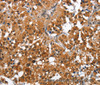 Immunohistochemistry of paraffin-embedded Human thyroid cancer tissue using CAMK1D Polyclonal Antibody at dilution 1:50