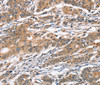 Immunohistochemistry of paraffin-embedded Human gasrtic cancer tissue using CAMK4 Polyclonal Antibody at dilution 1:40